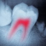 Private Health Insurance for Dental Work - image tooth-decay-large-150x150 on https://www.foundationdental.com.au