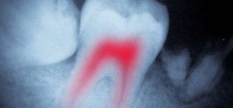 Dental X-ray showing a tooth with a red-highlighted infection, used for diagnosis at Foundation Dental Services